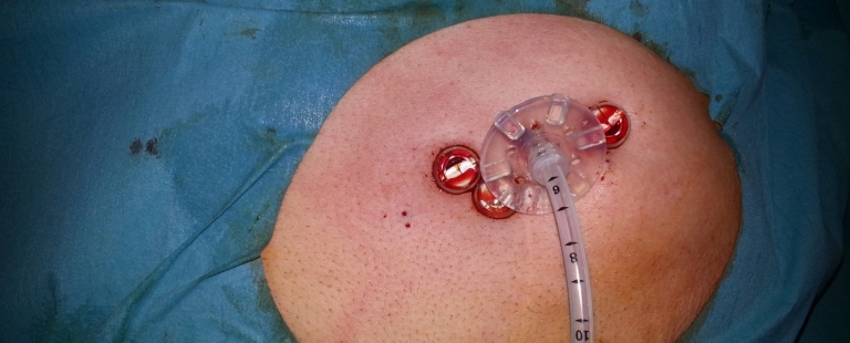 workshop-enfermagem-ostomia-alimentacao