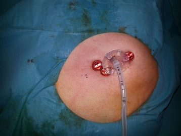 Workshop de Ostomia de Alimentação